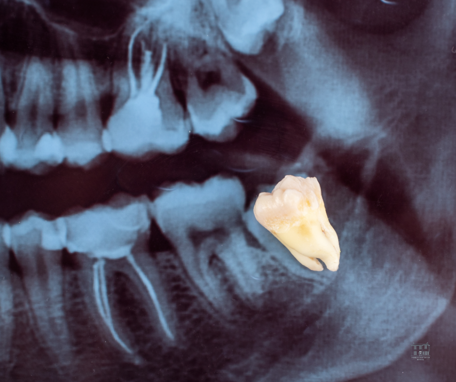 Close up of a wisdom tooth X-ray. 